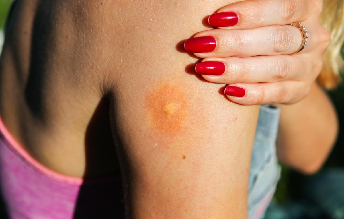 Essential oils for itchy bug bites - Cliganic